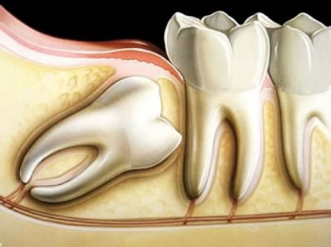 extração de dente caraguatatuba