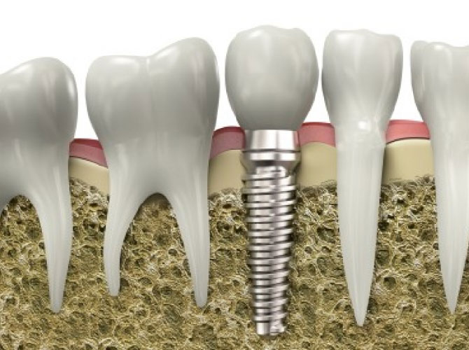 implantes dentarios caraguatatuba